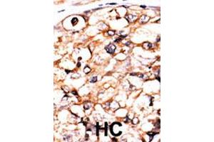 Formalin-fixed and paraffin-embedded human hepatocellular carcinoma tissue reacted with PGK2 polyclonal antibody  , which was peroxidase-conjugated to the secondary antibody, followed by AEC staining. (PGK2 antibody  (N-Term))