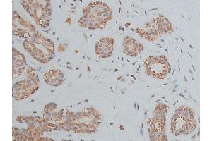 ABIN6268905 at 1/50 staining human breast cancer tissue sections by IHC-P. (OCT4 antibody  (Internal Region))