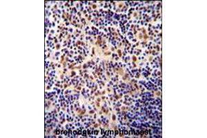 TIGD3 antibody immunohistochemistry analysis in formalin fixed and paraffin embedded human hodgkin lymphoma followed by peroxidase conjugation of the secondary antibody and DAB staining. (TIGD3 antibody  (C-Term))
