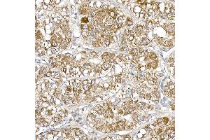 Immunohistochemistry of paraffin-embedded human liver cancer using S Rabbit mAb (ABIN7270501) at dilution of 1:250 (40x lens). (SAMM50 antibody)