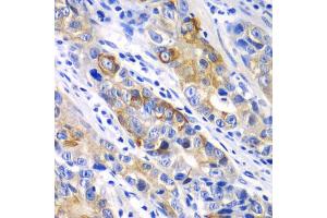 Immunohistochemistry of paraffin-embedded human gastric cancer using BCL2 antibody. (Bcl-2 antibody)