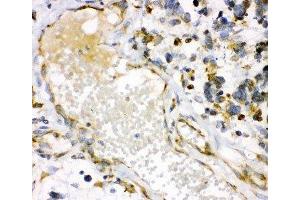 IHC-P: HO-1 antibody testing of human lung cancer tissue (HMOX1 antibody  (AA 1-288))