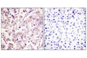 Immunohistochemical analysis of paraffin-embedded human breast carcinoma tissue, using ETS1 (Phospho-Thr38) antibody (left)or the same antibody preincubated with blocking peptide (right). (ETS1 antibody  (pThr38))