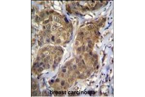 RNF11 Antibody (Center) (ABIN656832 and ABIN2846041) immunohistochemistry analysis in formalin fixed and paraffin embedded human breast carcinoma followed by peroxidase conjugation of the secondary antibody and DAB staining. (RNF11 antibody  (AA 64-90))