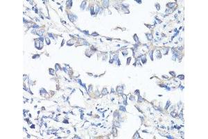 Immunohistochemistry of paraffin-embedded Human lung cancer using P Glycoprotein Polyclonal Antibody at dilution of 1:100 (40x lens). (P-Glycoprotein antibody)