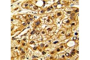 IHC analysis of FFPE human hepatocarcinoma stained with CD11c antibody (CD11c antibody  (AA 1119-1145))