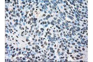 Immunohistochemical staining of paraffin-embedded Adenocarcinoma of breast tissue using anti-MAPK1 mouse monoclonal antibody. (ERK2 antibody)