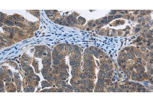 Immunohistochemistry of paraffin-embedded Human ovarian cancer tissue using SYT3 Polyclonal Antibody at dilution 1:40 (Synaptotagmin 3 antibody)