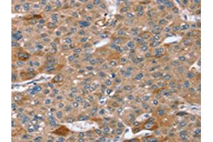The image on the left is immunohistochemistry of paraffin-embedded Human liver cancer tissue using ABIN7192629(SPATA5L1 Antibody) at dilution 1/20, on the right is treated with synthetic peptide. (SPATA5L1 antibody)