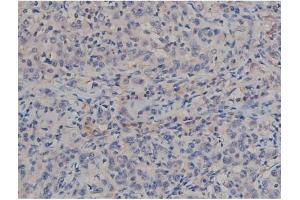 ABIN6267357 at 1/200 staining Human ganstric cancer tissue sections by IHC-P. (MAPT antibody  (pSer422))