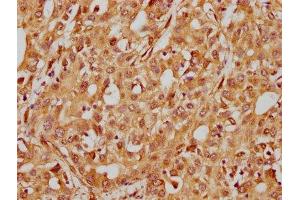 IHC image of ABIN7127584 diluted at 1:185 and staining in paraffin-embedded human liver cancer performed on a Leica BondTM system. (Recombinant ITGB1 antibody)