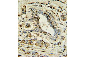 OL1 Antibody 7361a IHC analysis in formalin fixed and paraffin embedded human breast carcinoma followed by peroxidase conjugation of the secondary antibody and DAB staining. (APOL1 antibody  (AA 137-171))