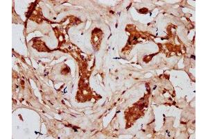 IHC image of ABIN7148040 diluted at 1:300 and staining in paraffin-embedded human breast cancer performed on a Leica BondTM system. (Codanin 1 (CDNA1) (AA 62-249) antibody)