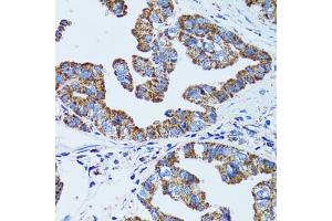 Immunohistochemistry of paraffin-embedded human gastric cancer using GIP antibody. (GIP antibody)