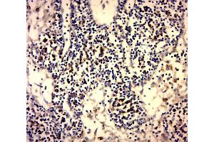 Paraformaldehyde-fixed, paraffin embedded Human Cervical Cancer, Antigen retrieval by boiling in sodium citrate buffer (pH6. (Galectin 3 antibody  (AA 151-250))
