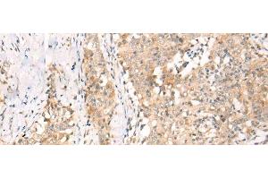 Immunohistochemistry of paraffin-embedded Human esophagus cancer tissue using YRDC Polyclonal Antibody at dilution of 1:30(x200) (YRDC antibody)