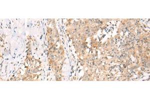 Immunohistochemistry of paraffin-embedded Human esophagus cancer tissue using YRDC Polyclonal Antibody at dilution of 1:30(x200) (YRDC antibody)