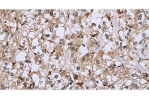 Immunohistochemistry of paraffin-embedded Human prostate cancer using CD32 Polyclonal Antibody at dilution of 1:40 (Fc gamma RII (CD32) antibody)