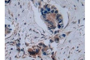 Detection of C2CD3 in Human Breast cancer Tissue using Polyclonal Antibody to C2 Calcium Dependent Domain Containing Protein 3 (C2CD3) (C2CD3 antibody  (AA 1432-1647))