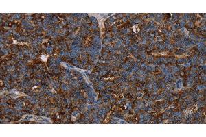 Immunohistochemistry of paraffin-embedded Human ovarian cancer using HMGCL Polyclonal Antibody at dilution of 1:30 (HMGCL antibody)
