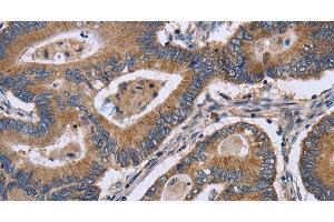 Immunohistochemistry of paraffin-embedded Human colon cancer using GABPB2 Polyclonal Antibody at dilution of 1:30 (GABPB2 antibody)