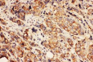 Anti-HDAC2 antibody,  IHC(P) IHC(P): Human Mammary Cancer Tissue (HDAC2 antibody  (C-Term))