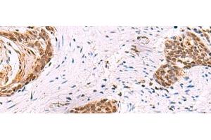 Immunohistochemistry of paraffin-embedded Human esophagus cancer tissue using CREBBP Polyclonal Antibody at dilution of 1:35(x200) (CBP antibody)