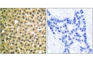 Immunohistochemistry analysis of paraffin-embedded human breast carcinoma tissue, using Retinoic Acid Receptor beta Antibody. (Retinoic Acid Receptor beta antibody  (AA 331-380))