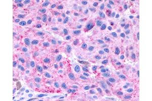Anti-NPBWR1 / GPR7 antibody IHC of human Skin, Melanoma. (NPBWR1 antibody  (Cytoplasmic Domain))