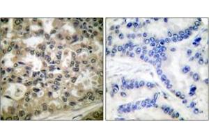 Immunohistochemistry analysis of paraffin-embedded human lung carcinoma, using IkappaB-beta (Phospho-Ser23) Antibody. (NFKBIB antibody  (pSer23))
