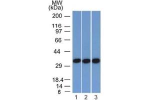 IHC testing of FFPE human colorectal carcinoma and anti-EpCAM antibody (clone EGP40/1372).