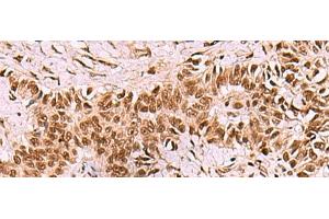 Immunohistochemistry of paraffin-embedded Human ovarian cancer tissue using LDB1 Polyclonal Antibody at dilution of 1:70(x200)