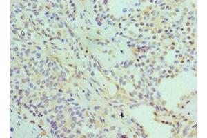 Immunohistochemistry of paraffin-embedded human breast cancer using ABIN7142216 at dilution of 1:100 (PSMD5 antibody  (Regulatory Subunit 5))