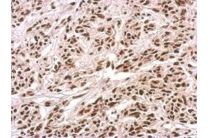 IHC-P Image PUF60 antibody detects PUF60 protein at nucleus on U251 xenograft by immunohistochemical analysis. (PUF60 antibody)