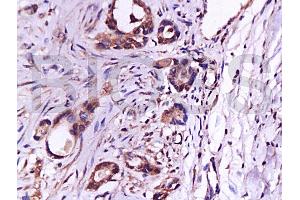 Formalin-fixed and paraffin embedded human gastric carcinoma labeled with Anti-CD105 Polyclonal Antibody (ABIN670401), Unconjugated at 1:200, followed by conjugation to the secondary antibody and DAB staining (Endoglin antibody  (AA 601-658))