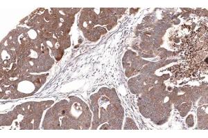 IHC-P Image Immunohistochemical analysis of paraffin-embedded Gastric CA N87 xenograft, using CDA, antibody at 1:100 dilution. (CDA antibody)