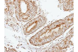 IHC-P Image Immunohistochemical analysis of paraffin-embedded human colon carcinoma, using EIF2B beta, antibody at 1:250 dilution. (eIF2B beta (Center) antibody)