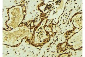 ABIN6274338 at 1/100 staining Human breast cancer tissue by IHC-P.