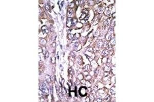 Formalin-fixed and paraffin-embedded human cancer tissue reacted with the primary antibody, which was peroxidase-conjugated to the secondary antibody, followed by AEC staining. (ATG4A antibody  (AA 82-111))