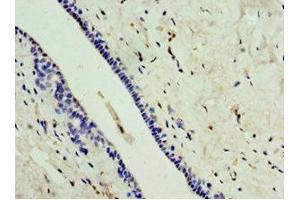 Immunohistochemistry of paraffin-embedded human breast cancer using ABIN7146735 at dilution of 1:100 (CA8 antibody  (AA 1-290))