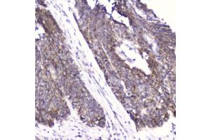 IHC testing of FFPE human esophageal squamous cell carcinoma with FABP3 antibody at 2ug/ml.