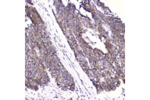 IHC testing of FFPE human esophageal squamous cell carcinoma with FABP3 antibody at 2ug/ml. (FABP3 antibody  (AA 2-133))