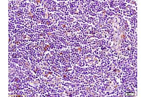 Formalin-fixed and paraffin embedded human pancreatic cancer tissue labeled with Anti-CD1A Polyclonal Antibody, Unconjugated (ABIN702700) at 1:200 followed by conjugation to the secondary antibody and DAB staining