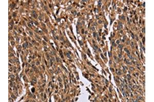 The image on the left is immunohistochemistry of paraffin-embedded Human lung cancer tissue using ABIN7129718(HMGN5 Antibody) at dilution 1/20, on the right is treated with fusion protein.