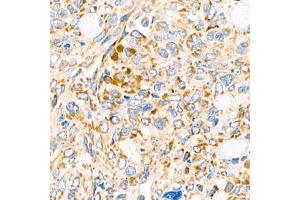 Immunohistochemistry analysis of paraffin-embedded human ovary cancer using Torsin A (ABIN7075942) at dilution of 1:800 (TOR1A antibody)