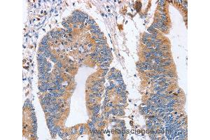 Immunohistochemistry of Human colon cancer using SIGLEC6 Polyclonal Antibody at dilution of 1:70
