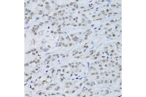 Immunohistochemistry of paraffin-embedded human colon carcinoma using SNRNP70 antibody. (SNRNP70 antibody  (AA 150-250))