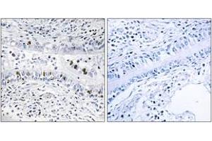Immunohistochemistry analysis of paraffin-embedded human lung carcinoma tissue, using EZH1 Antibody. (EZH1 antibody  (AA 171-220))