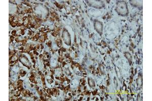 Immunoperoxidase of monoclonal antibody to STK4 on formalin-fixed paraffin-embedded human stomach carcinoma tissue.