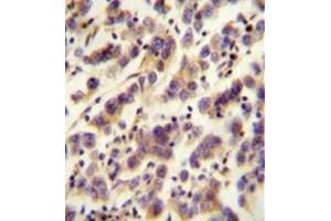 Immunohistochemistry analysis in formalin fixed and paraffin embedded human testis carcinoma reacted with OR1J4 Antibody (C-term) followed which was peroxidase conjugated to the secondary antibody and followed by DAB staining.